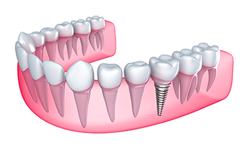 Dental Implants | Dentist In Colorado Springs CO | Nolan R. Behr, DDS